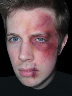 face bruised.jpg